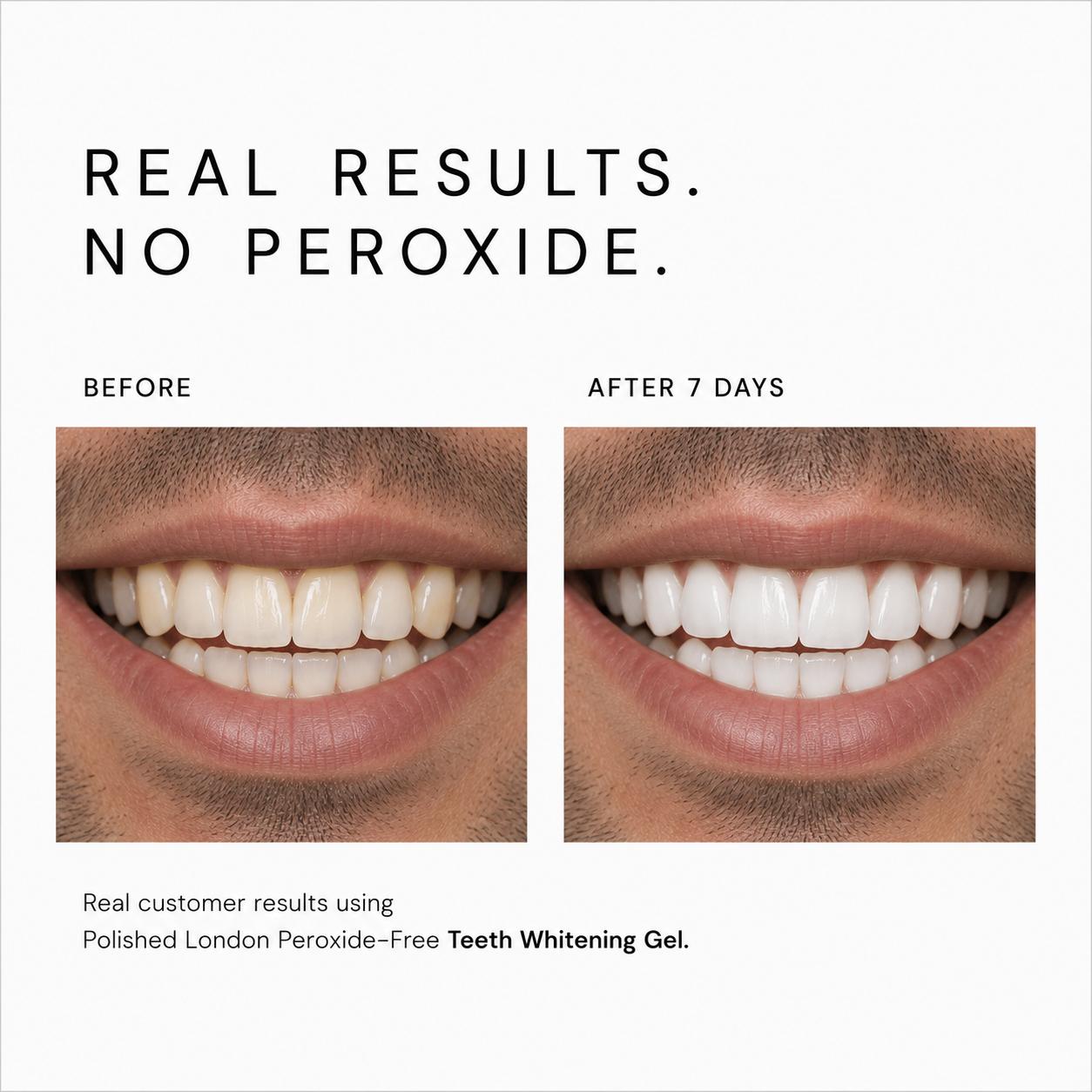 Advanced Teeth Whitening Gel Refills x 3